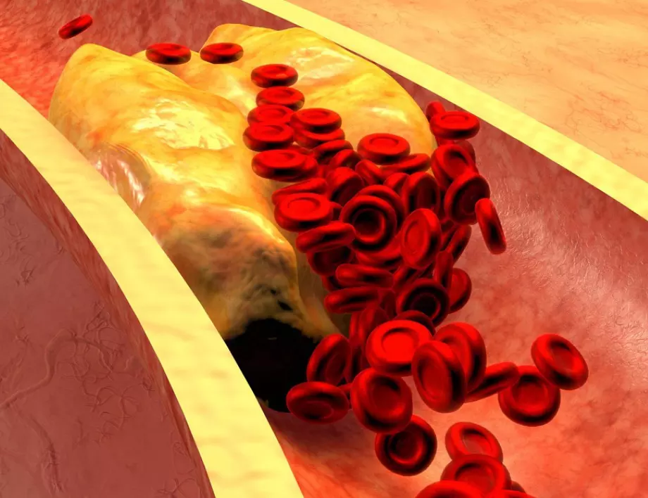 Висок холестерол: Подуването в тези части на тялото издава стесняване на артериите