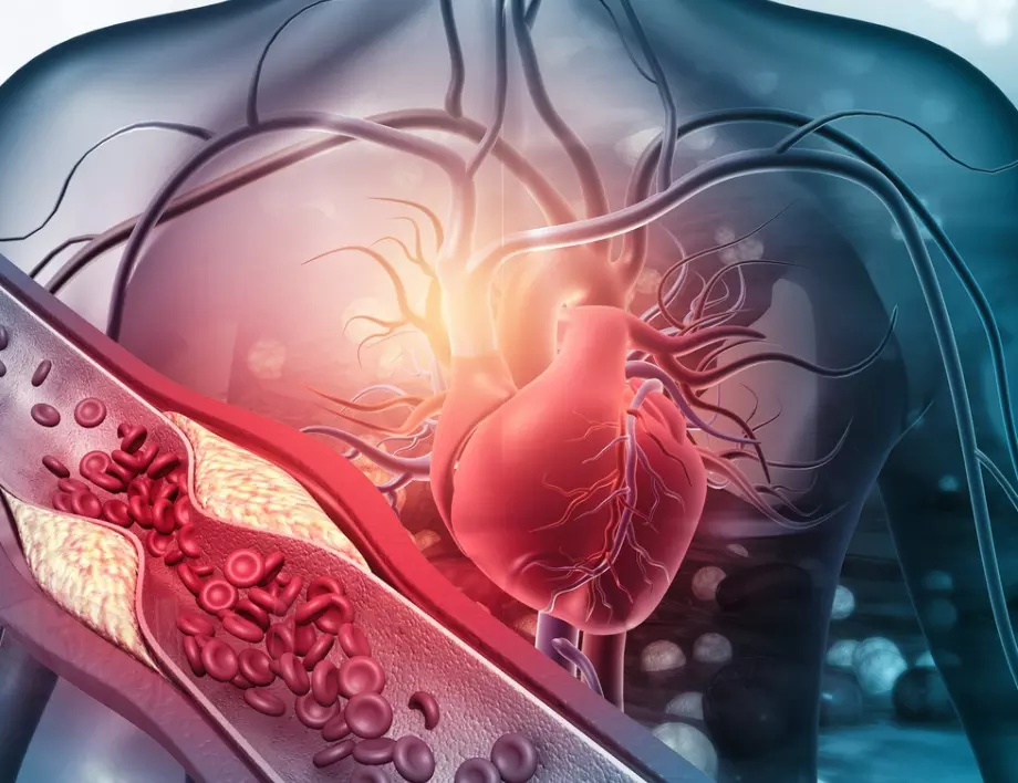 6 симптома, които издават, че високият холестерол е засегнал сърцето